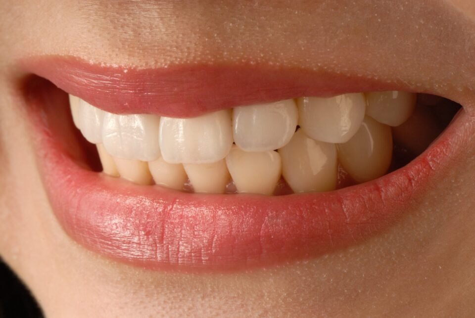 how much do veneers cost in mexico