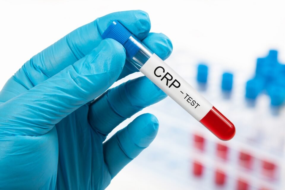 Everything You Need To Know About CRP Blood Test