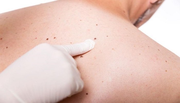 how to remove moles