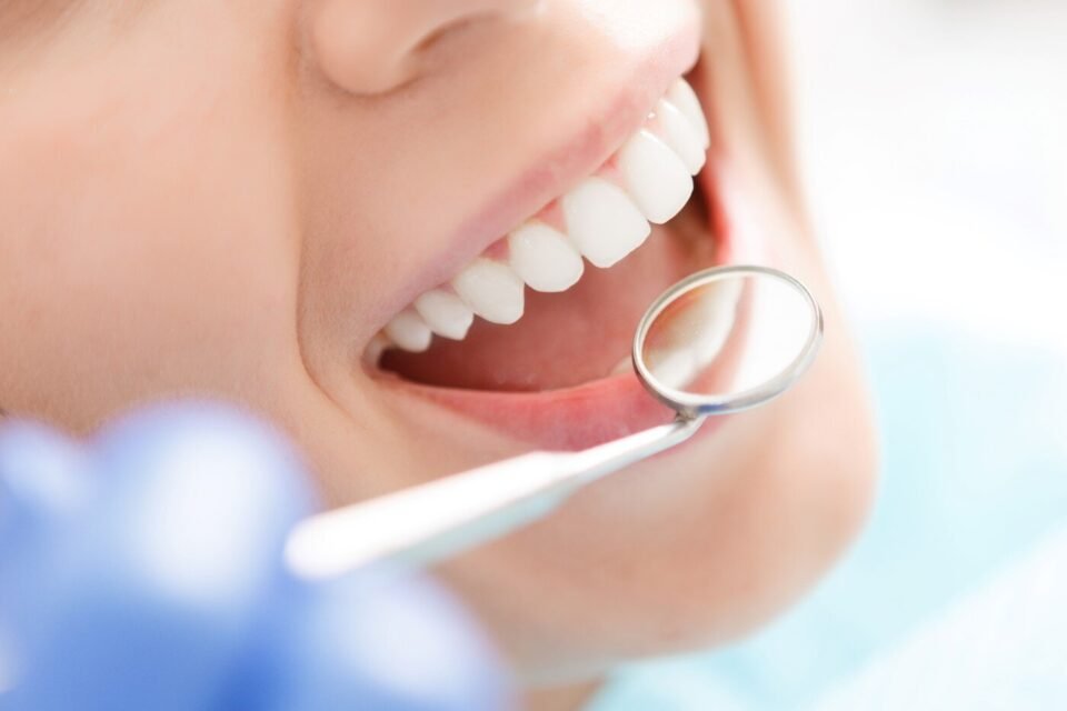 The Benefits Of Professional Teeth Whitening