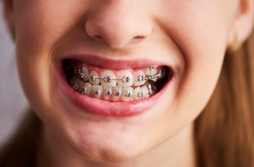 Traditional Braces