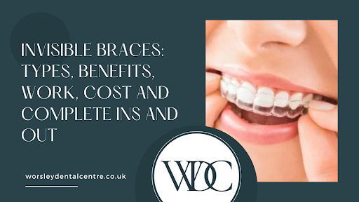 Invisible Braces: Types, Benefits, Work, Cost and Complete Ins and Out